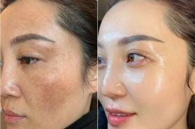 Da yếu, nám, mụn lâu năm có điều trị dứt điểm được không? Spa Nữ Hoàng giải đáp